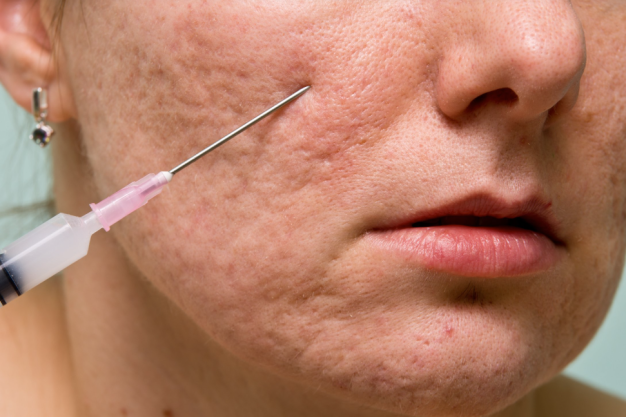 Acne Scar Subcision