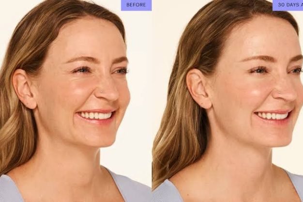 Botox
