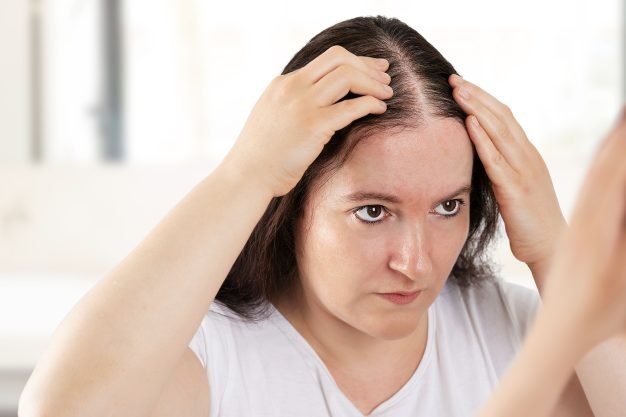 Female Pattern Hair Loss
