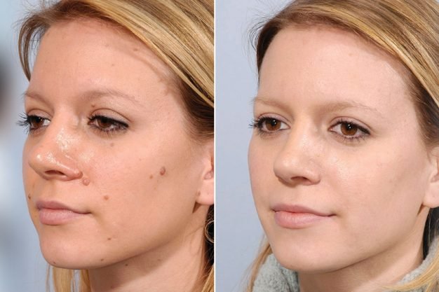 Laser Mole Removal