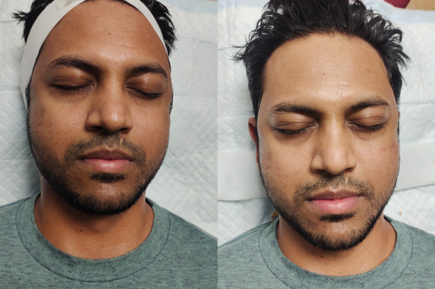 Laser Pigmentation & Tanning Treatment