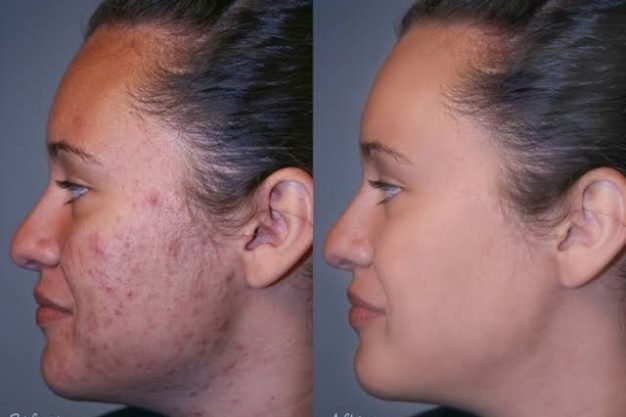 Laser Scar Treatment