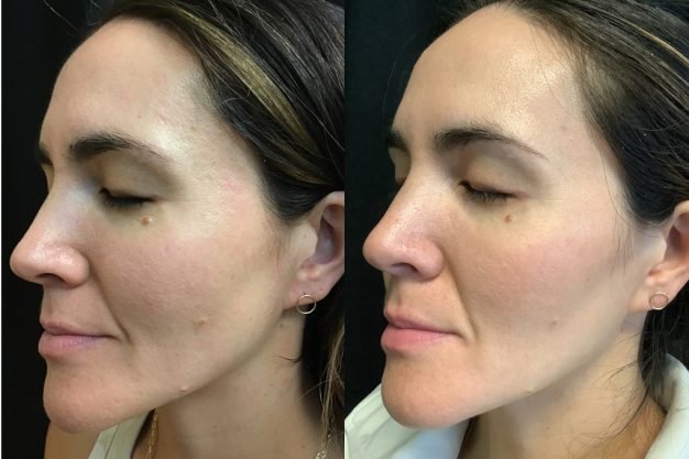 Laser Skin Rejuvenation