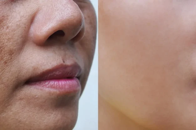 Melasma & Pigmentation