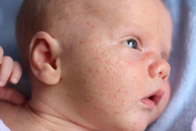 Pediatric Skin Disease