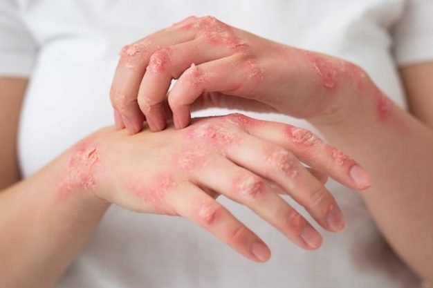 Psoriasis
