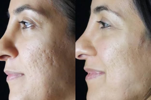 Punch Grafting for Acne Scars