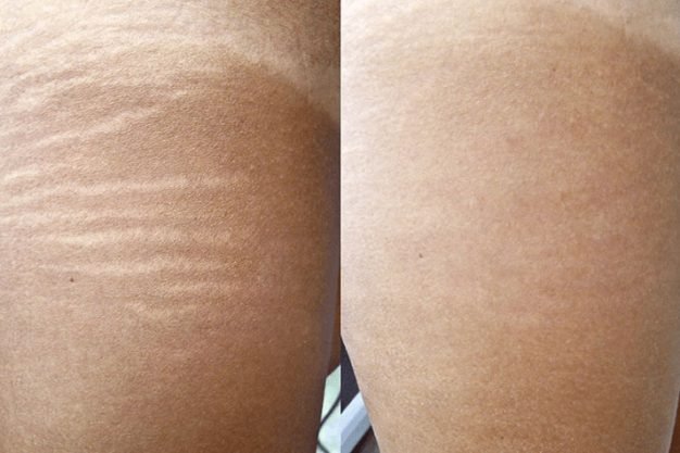 Stretch Mark Treatment