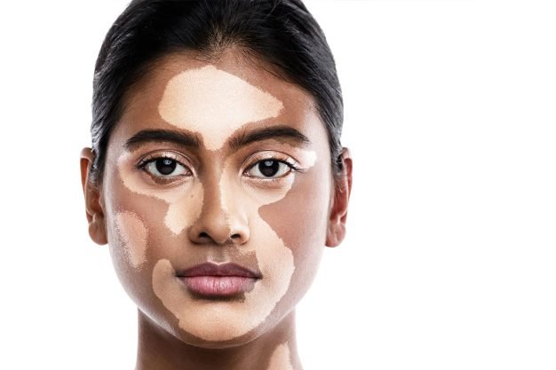 Vitiligo