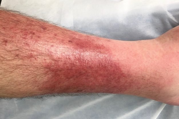 cellulitis