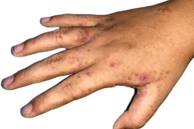 scabies_0
